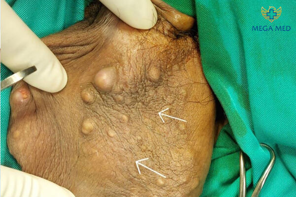 Hình ảnh u nang tuyến bã vùng bìu